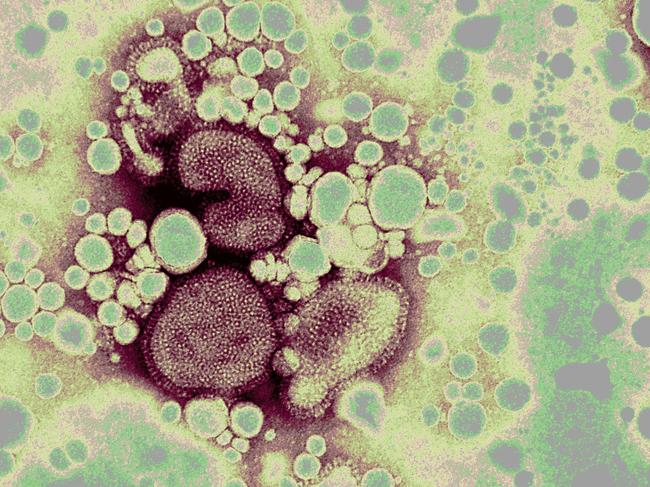 07/11/2005. Bird flu virus globules under the microscope. Pic From CSIRO, Livestock Industries Australian Animal Health Laboratory, Geelong.