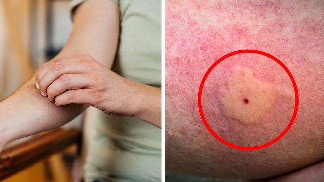 An Aussie mozzie expert has shed light on why some people may have worse reactions to mosquito bites than others. Picture: Instagram