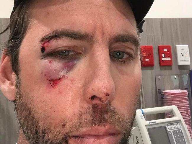 Bruised....Hackett’s shocking Instagram post.