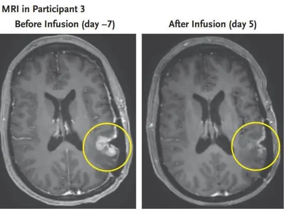 A woman's brain tumour nearly completely regressed five days after having CAR-T therapy. Picture: New England Journal of Medicine