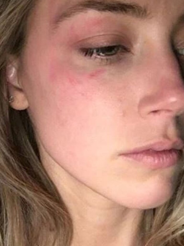 Amber Heard bruised after alleged abuse by Johnny Depp