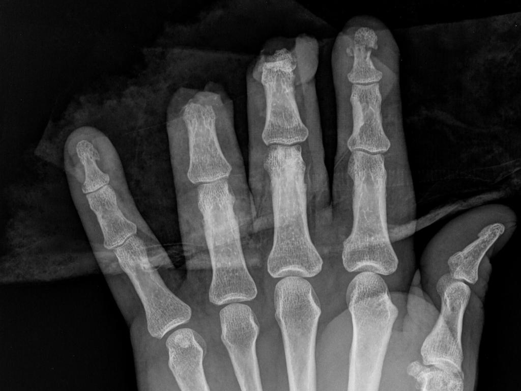 This patient severed three fingers while using a lawnmower. Picture: Supplied