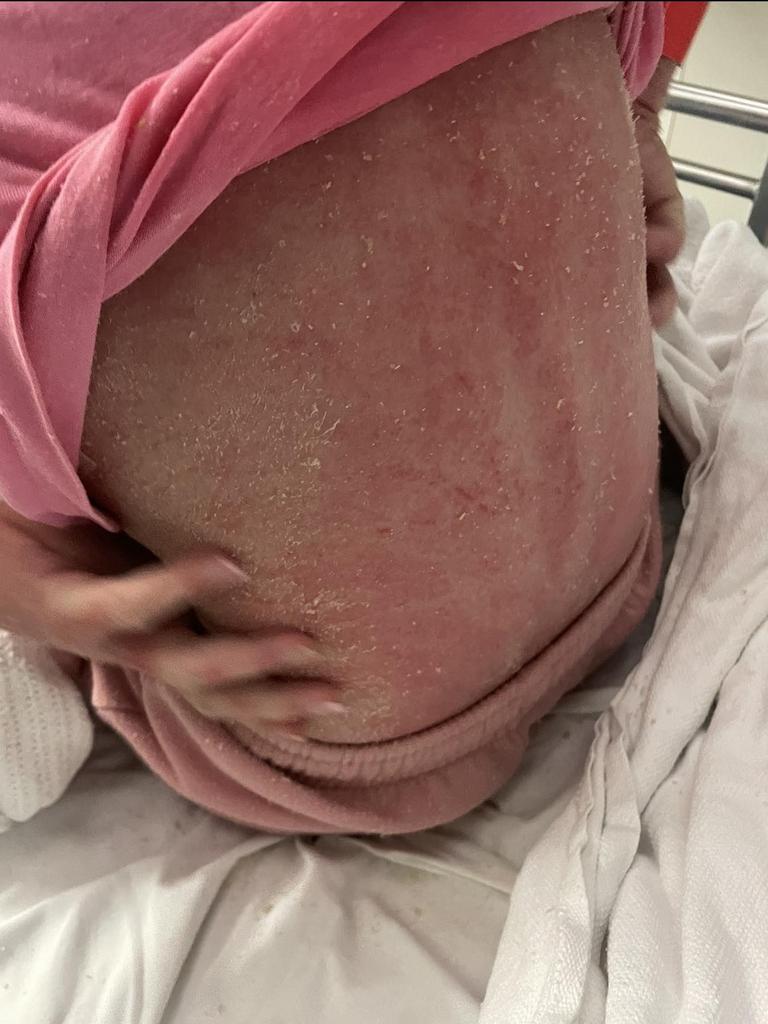 Her back inflamed and cracked from the skin condition. Picture: Supplied