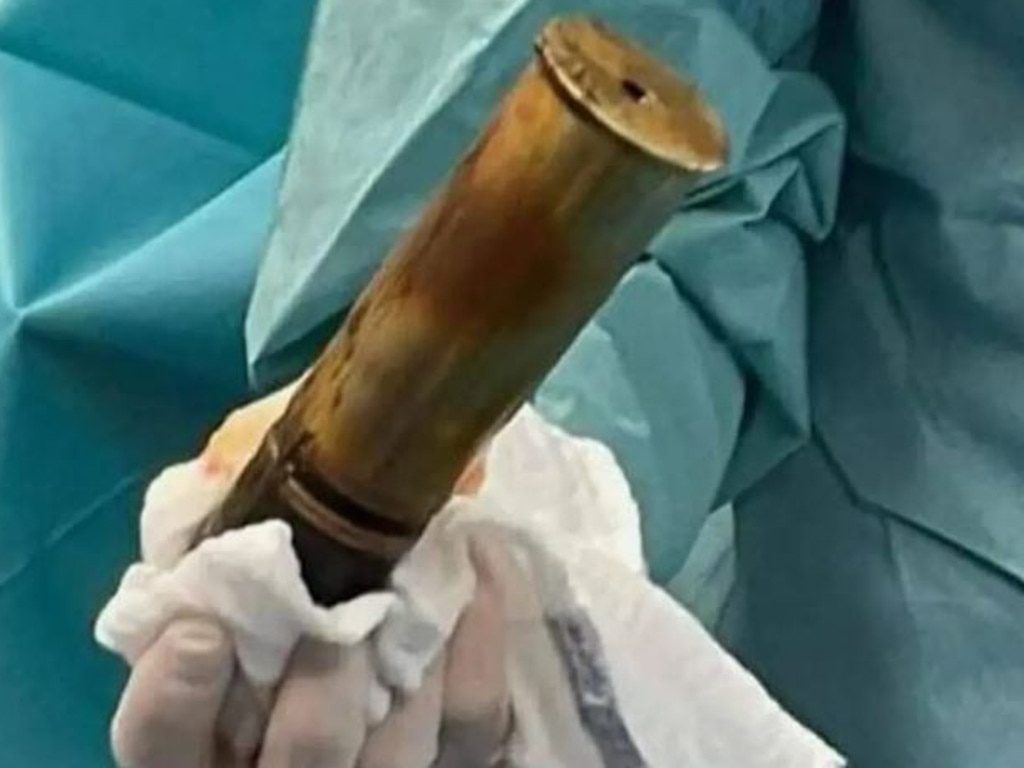 A WWI shell was found in a Frenchman's derriere. Picture: Twitter