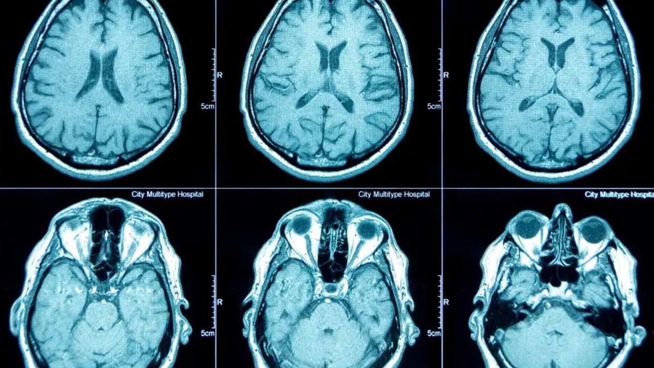 Brain scans taken over a 15 year period show how poor sleep habits can age the brain. Picture: