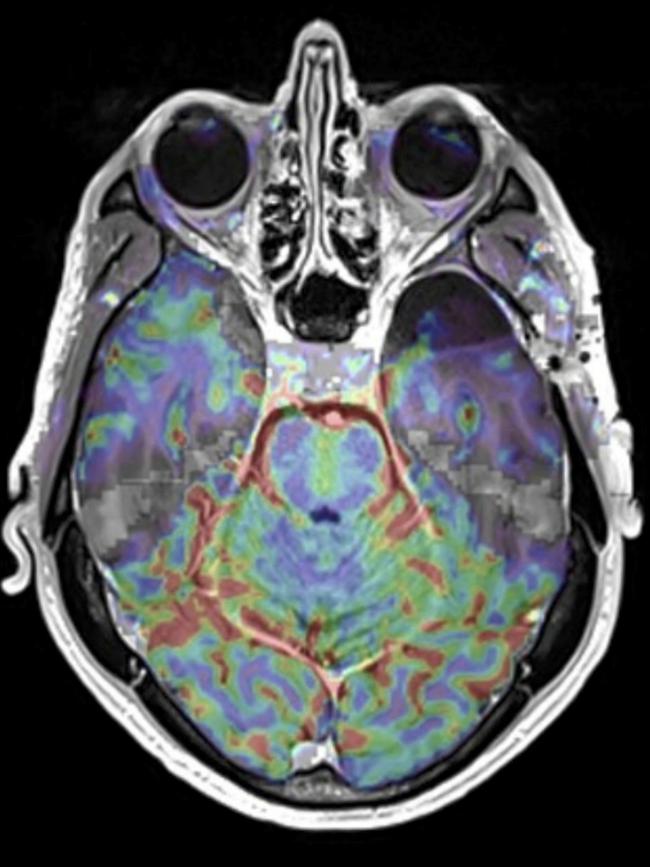 Professor Richard Scolyer has gone 10 months without seeing the return of his glioblastoma. Picture: Supplied