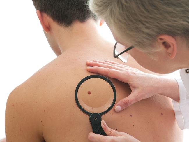 A dermatologist examines a mole of male patient. Picture: istock