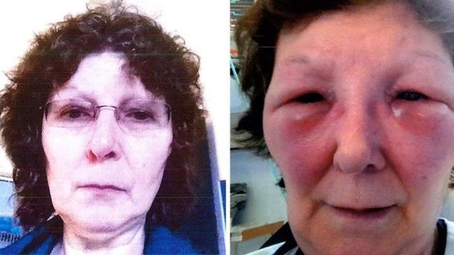 Botox: Botched procedure ‘left me looking like a hamster’ | news.com.au ...