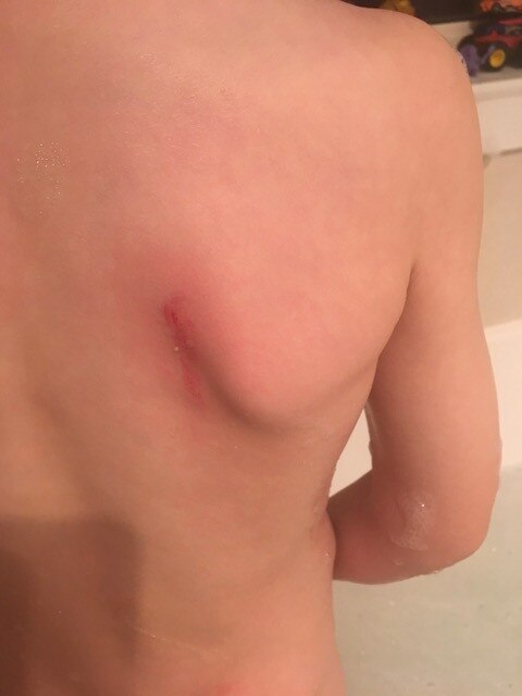 The injury to his son’s back Mr Batten says was caused by an ill-fitting bathroom fixture.