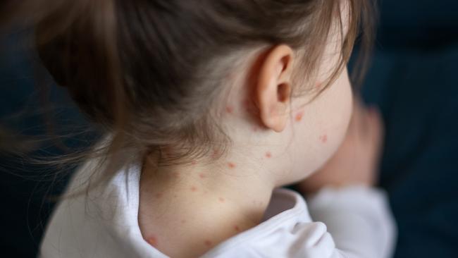 Health authorities are warning NSW and ACT residents to be cautious after an international traveller brought home a case of the dangerous disease.