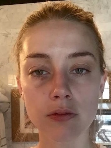 Amber Heard displaying injuries allegedly sustained during an incident with Depp. He strongly denies ever hitting Heard. Picture: Supplied