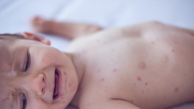 A health alert has been issued for measles by NSW Health. Picture: istock