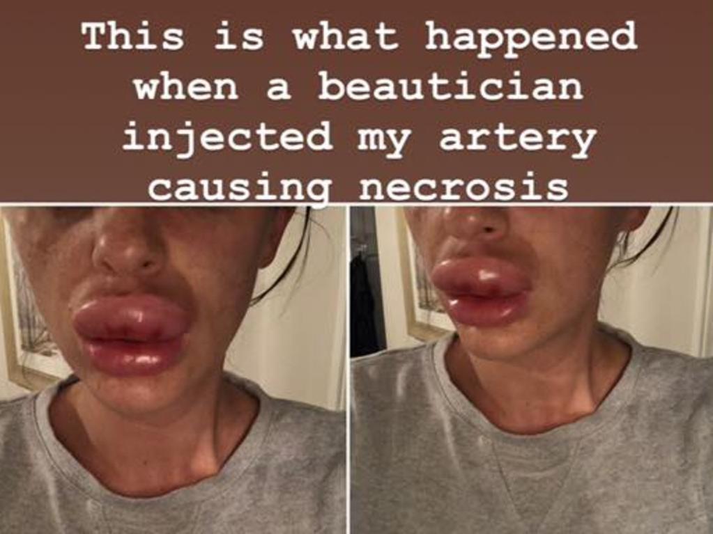400 Botox Party Leaves Woman In Agony With Swollen Lips Au 5045