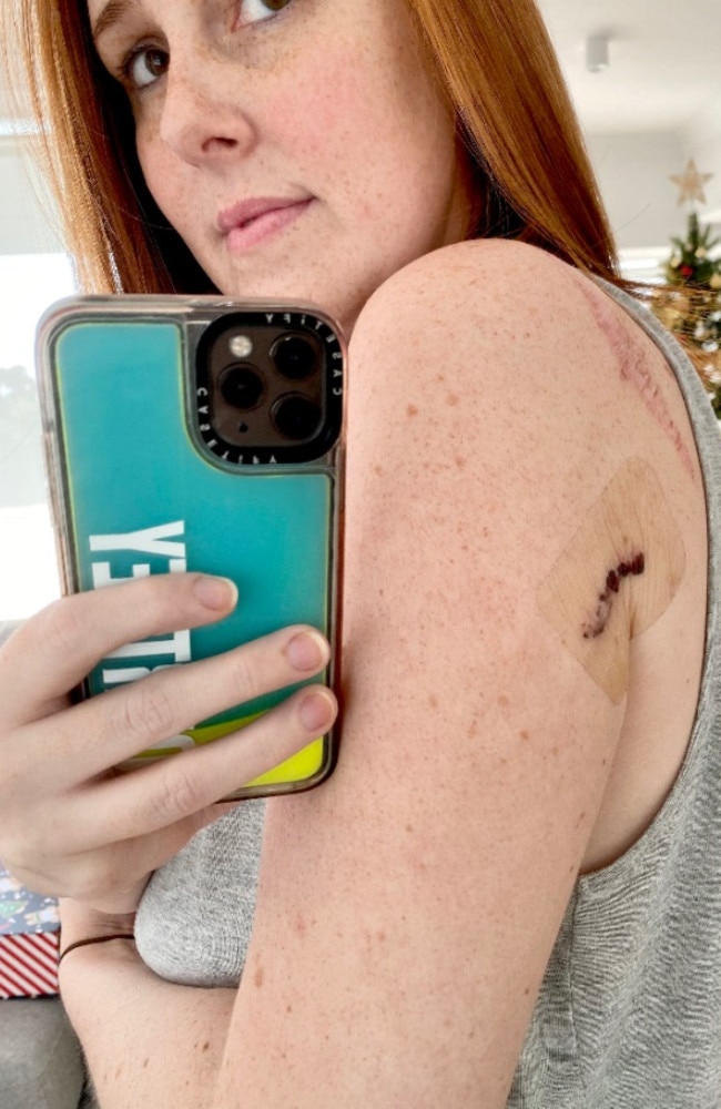 She was told it was nothing serious, but after visiting a skin specialist, she was diagnosed with a level 4 melanoma. Picture: Supplied