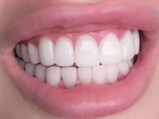 When she complained that the teeth were wonky, they said they had never told her they could fully straighten them. Picture: TikTok/@nikeishalouise