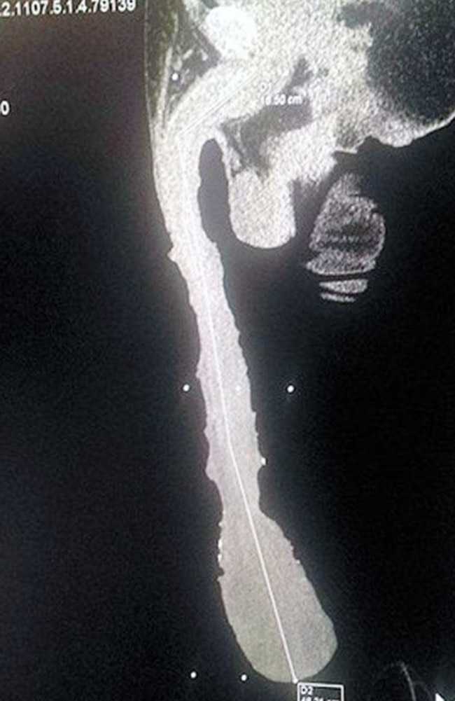 The real deal: An X-Ray of Mr Cabrera’s 48.2cm penis, which hangs down below his knees
