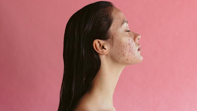 A dermatologist gives advice to acne patients about treatments including lasers and Roaccutane.