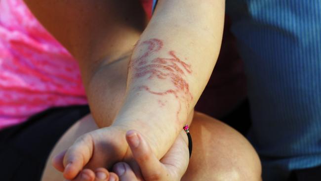 Benjamin Horsington was left with scars on his arm after getting a “black henna” tattoo in Bali. Picture: Ivan Rachman