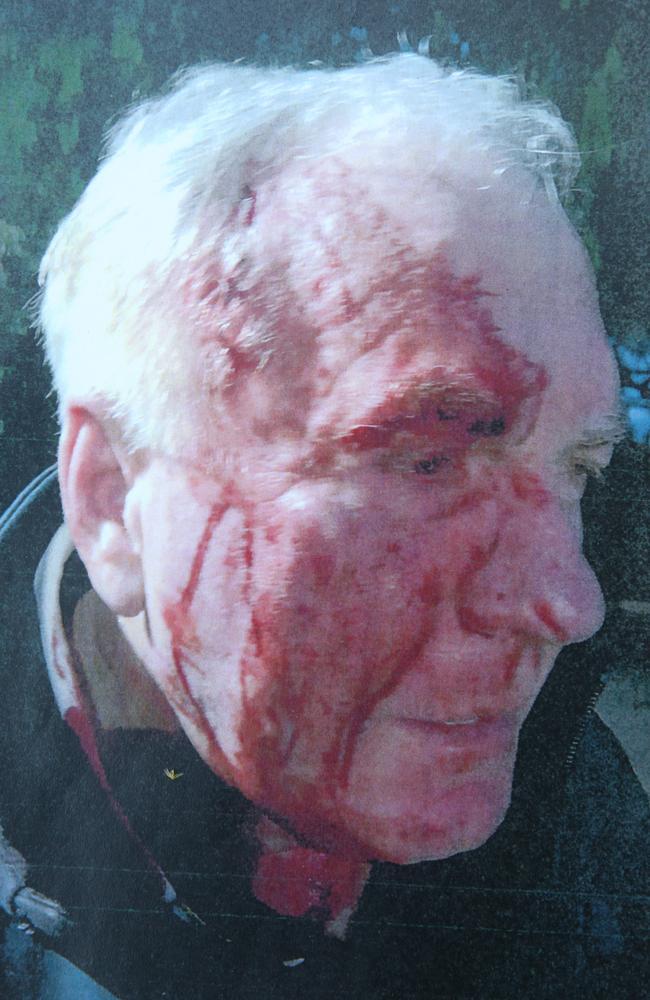 An image tendered to the court depicting injuries received by police Assistant Commissioner Chris O'Neill after he was bashed by Jay and Isaiah Stephens on June 15, 2019. Picture: Supplied.