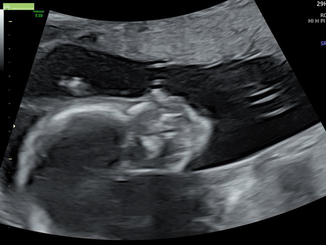 The baby’s side profile as seen on my 20-week scan.