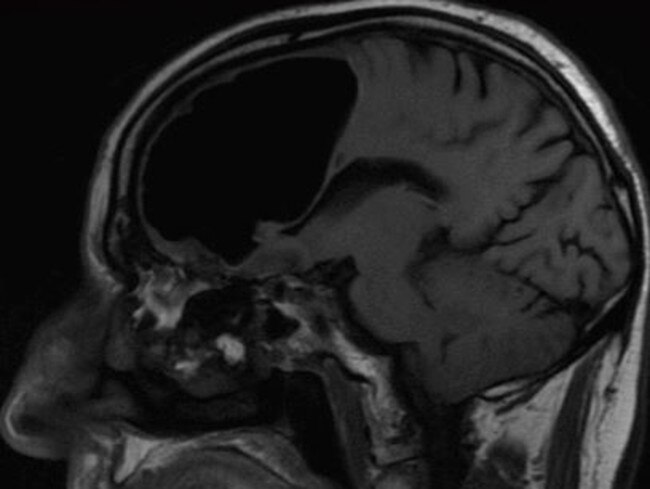 British Medical Journal Case Reports details man with 9cm air pocket in ...