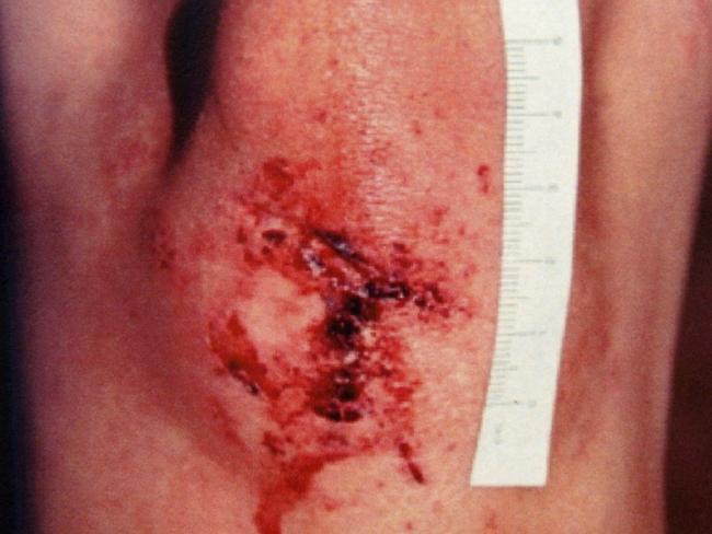 A police photograph of an injury to the leg of Joanne Lees following the assault.