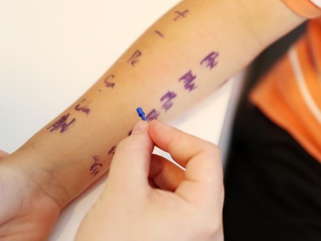 A skin prick allergy test. Photo: Tara Croser.