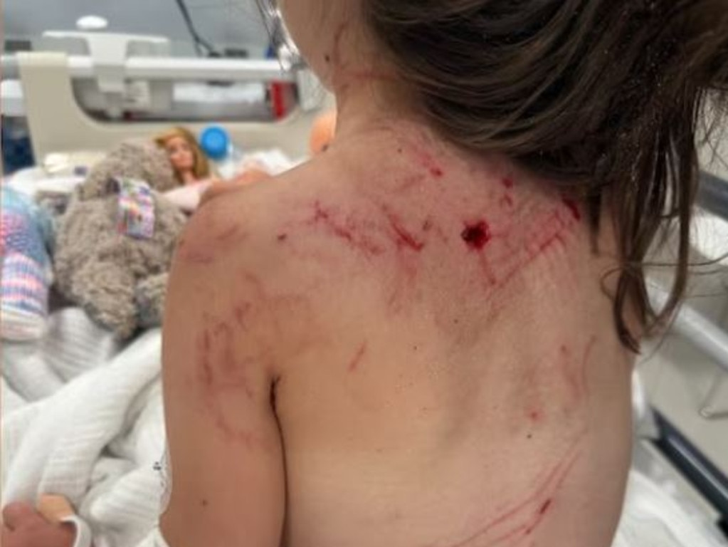 The little girl sustained multiple injuries to her body and limbs. Picture: ABC