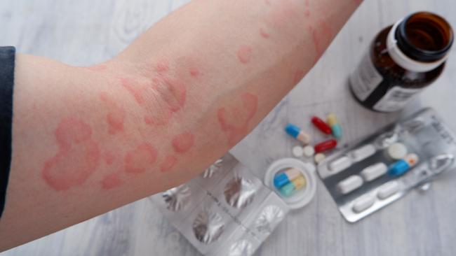 Hives are a common symptom of allergies. More than five million Australians are estimated to suffer allergies, with numbers on the rise. Picture: iStock