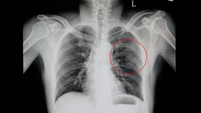 a chest x-ray of a blunt chest wall injuried patient showing fractured ribs 5, 6, 7, 8 on the left side(red cycle) with some pulmonary contusion