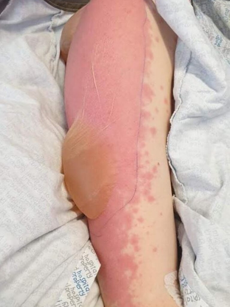 Her body was filled with blisters. Picture: Supplied