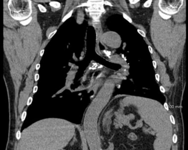 Doctors in the US conducted tests that determined part of Mr Cheng’s left lung had been removed.