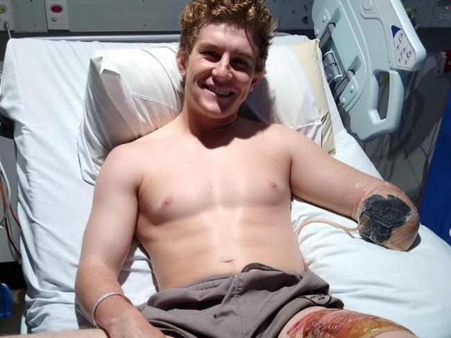 British backpacker Henry Dunn lost his lower left arm after a workplace accident on a remote Northern Territory cattle station.