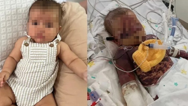 The five-month-old baby from Cairns northern beachs is fighting for life in Townsville Hospital after being stuck down with a severe case of meningococcal septicaemia. Picture: GoFundMe