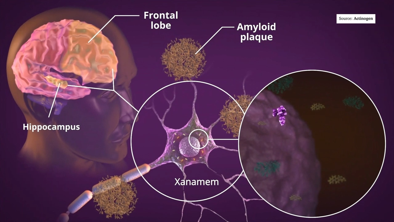 New breakthrough Alzheimer's treatment on trial