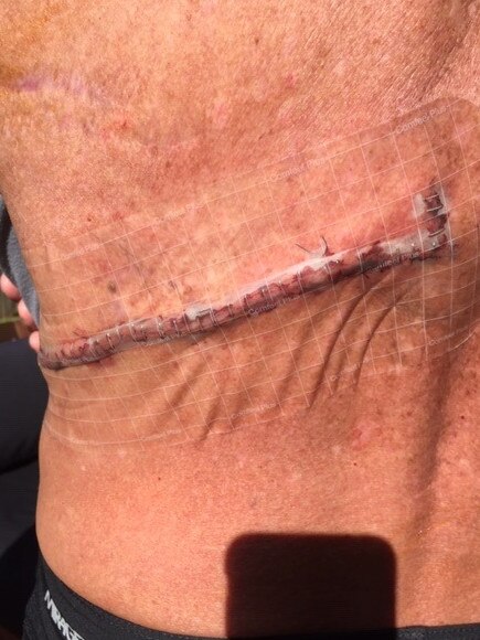 Leslie Watt, 70, of Manly, was a professional lifeguard and was diagnosed with melanoma on his back. He had multiple operations to remove the growth. Picture: Supplied.