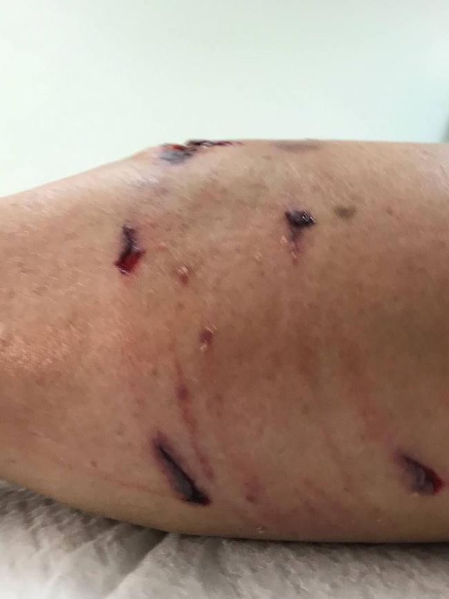 The result of a dog attack on an Ergon Energy worker in Queensland.