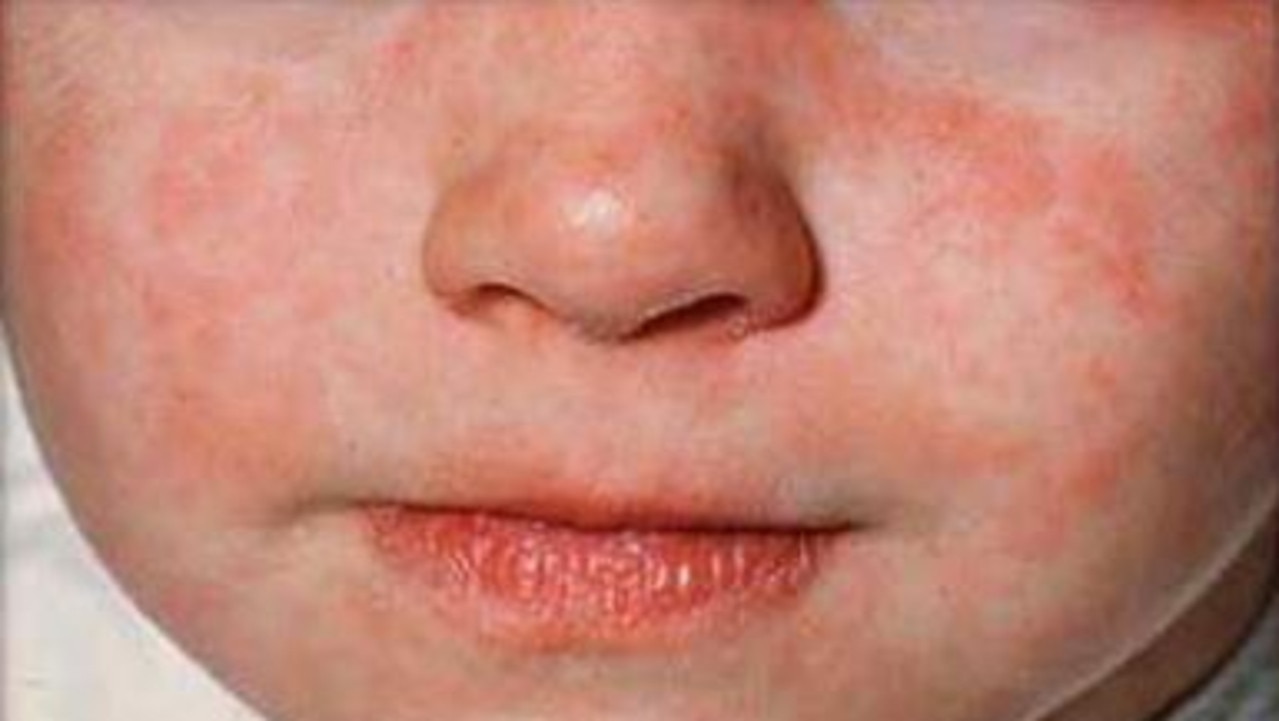 The telltale measles rash on a child. Picture: NSW Health