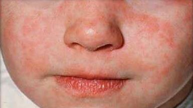 The telltale measles rash on a child. Picture: NSW Health