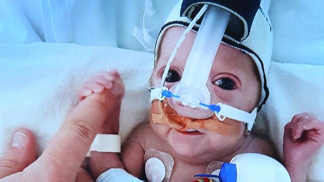 World First discovery in tiny babies - Monash Children's Hospital