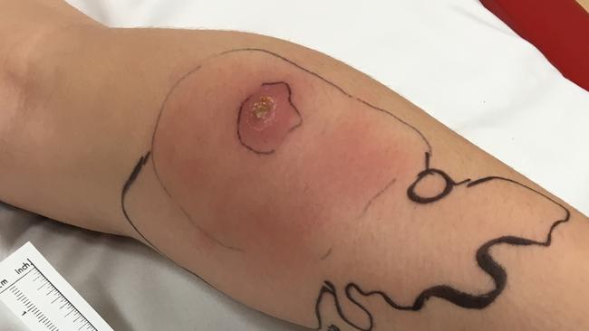 Seven-year-old Mia Spilman contracted the Buruli ulcer in Victoria’s Mornington Peninsula.