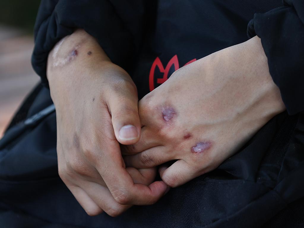 Benjamin Phikhohpoom still has scares on his hands from the assault. Picture: David Caird