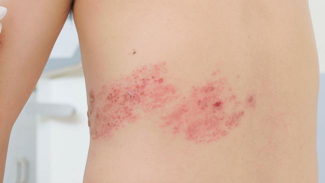 The shingles rash is terribly painful and can have long-lasting consequences.
