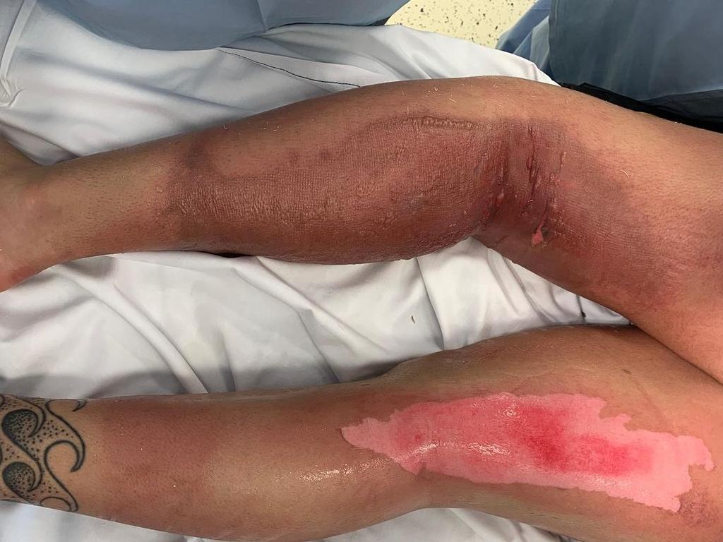 She was left with severe second-degree burns to her legs. Picture: Supplied