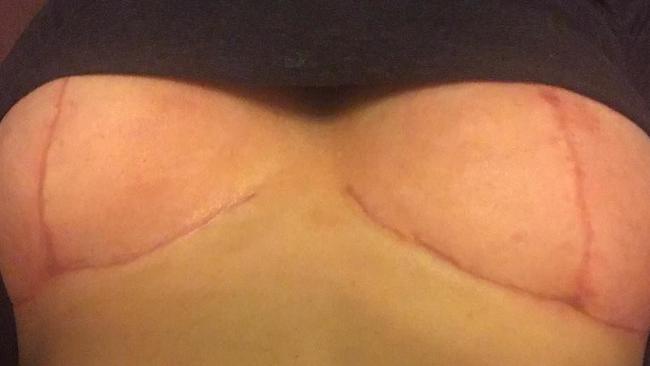 But despite the scars, she hopes her story is a lesson to others about getting implants.