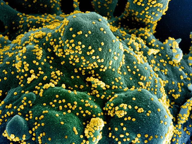 This scanning electron micrograph shows an apoptotic cell (blue/green) heavily infected with SARS-COV-2 virus particles (yellow). Picture: National Institute of Allergy and Infectious Diseases.