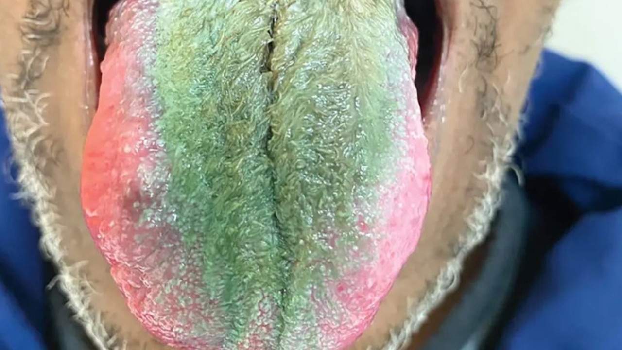 Smoker s tongue turns green spouts hair after rare reaction to