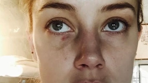 Amber Heard displaying injuries said to have been sustained during an incident in which Johnny Depp has admitted to "accidentally" head butting her at their Los Angeles penthouse. Picture: Supplied