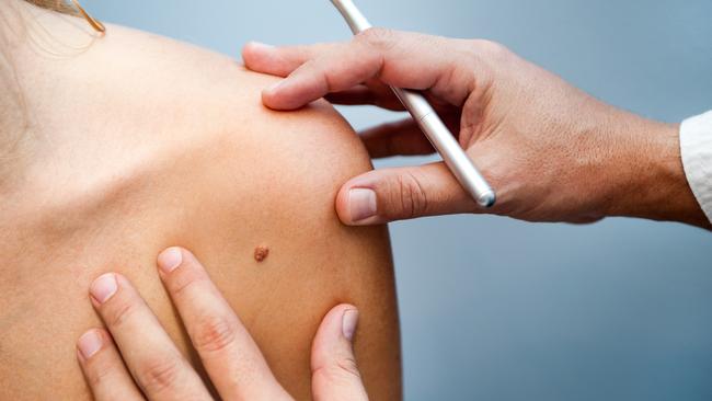 A new medical discovery has found a once overlooked cell can help fight melanoma