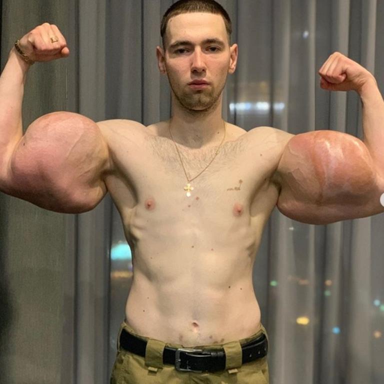 Tereshin injected his biceps with three litres of petroleum jelly. Picture: Supplied